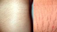   Some women experienced stretch marks during pregnancy, and some may not have any issues. It may appear everywhere, more common on breasts, belly, buttocks and thighs. Cosmetically this can […]