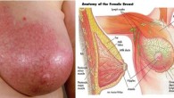 Mastitis is an inflammation of the breast tissue. It is usually experienced by breastfeeding moms. It is caused by a clogged duct in the nipple of a nursing mother. There […]
